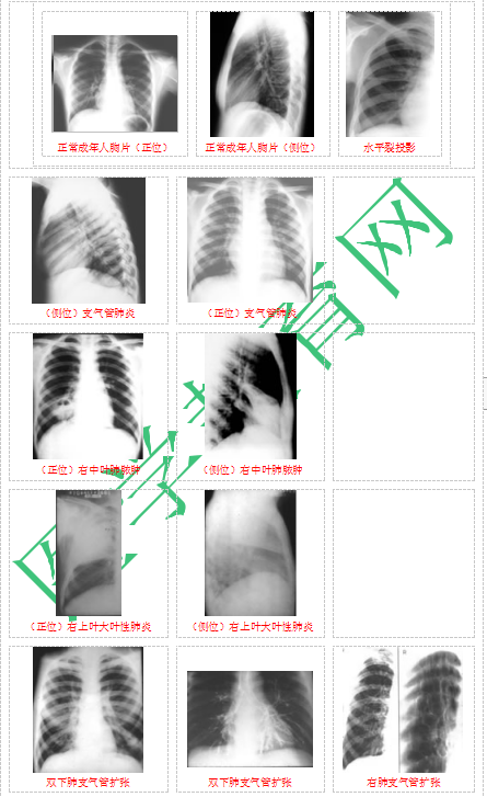 快收藏！臨床助理醫(yī)師實踐技能62個胸片（圖片診斷）
