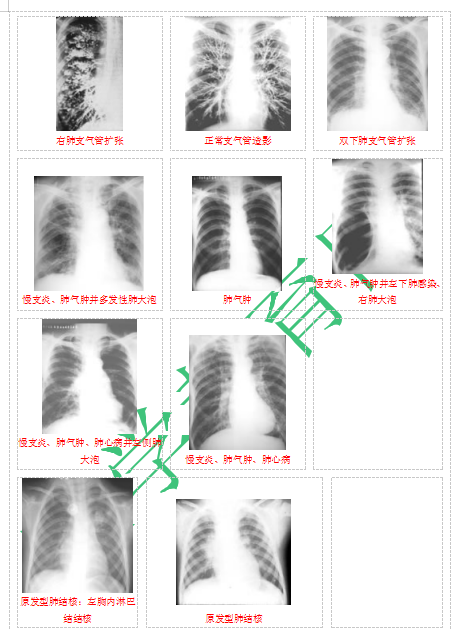 快收藏！臨床助理醫(yī)師實踐技能62個胸片（圖片診斷）