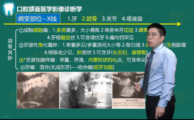 成釉細(xì)胞瘤X線(xiàn)特點(diǎn)